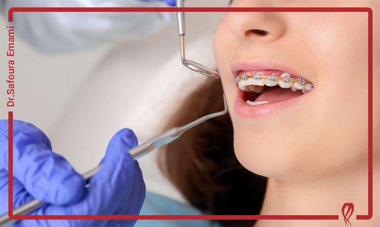 نکات مهم برای پوسیدگی دندان در ارتودنسی